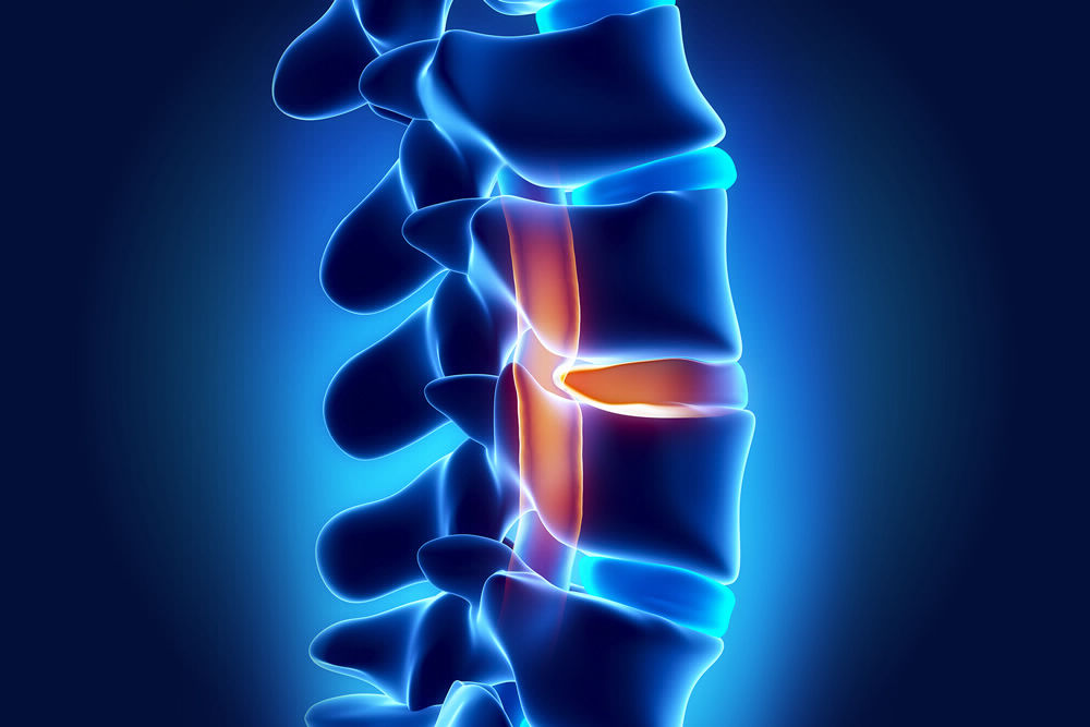 Neurosurgery Degenerative Disc