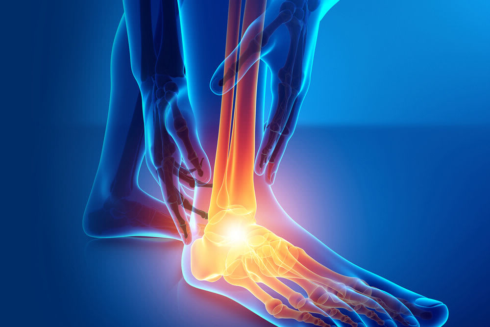 Neurosurgery Sciatica